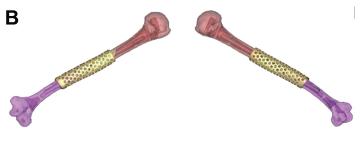 3D打印PEEK在俄乌战争中用于修复肱骨严重缺损
